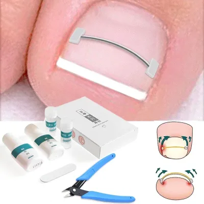 Fils correcteurs pour ongles incarnés, lot de 4
